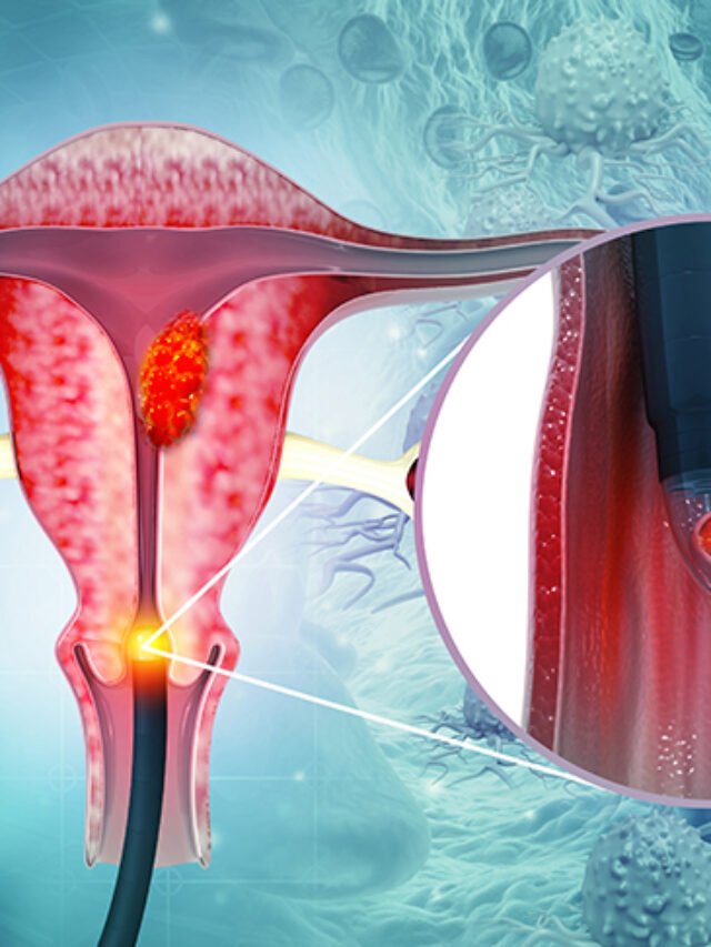 Understanding Cervical Cancer - Insights Care