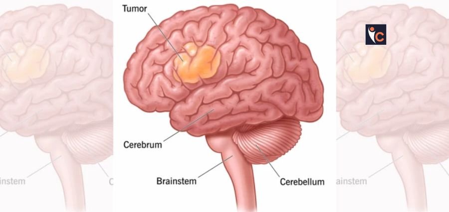 Brain Tumour